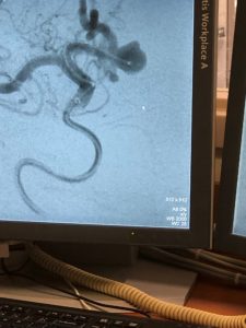 Image of monitor showing the catheter with the WEB device placed in the aneurysm.