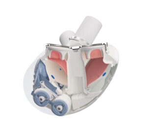 Aeson® total artificial heart showing Open view with pumps and electronics (blue), blood chambers (maroon) and conduits (top, white). Image courtesy CARMAT.