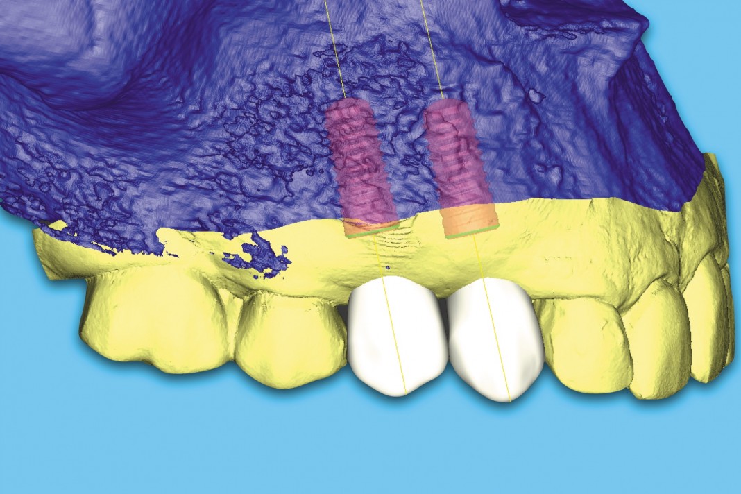 Virtual prosthetically driven surgical plan