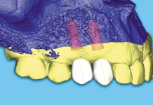 Virtual prosthetically driven surgical plan