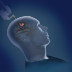 UofL neurosurgeons can now utilize the NeuroBlate laser system to remove lesions and tumors from the brain.