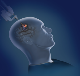 UofL neurosurgeons can now utilize the NeuroBlate laser system to remove lesions and tumors from the brain.