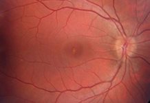 Photo showing solar photo-toxicity in the central retina, the yellow-white pigment irregularity in the center of the photo. Image © 2017 American Academy of Ophthalmology.