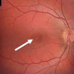 Photo showing solar photo-toxicity in the central retina, the yellow-white pigment irregularity highlighted by the arrow. Image © 2017 American Academy of Ophthalmology.