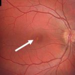 Photo showing solar photo-toxicity in the central retina, the yellow-white pigment irregularity highlighted by the arrow. Image © 2017 American Academy of Ophthalmology.
