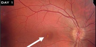 Photo showing solar photo-toxicity in the central retina, the yellow-white pigment irregularity highlighted by the arrow. Image © 2017 American Academy of Ophthalmology.