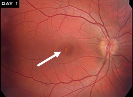 Photo showing solar photo-toxicity in the central retina, the yellow-white pigment irregularity in the center of the photo. Image © 2017 American Academy of Ophthalmology.