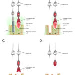 Figure showing progression of deterioration of rod and cone cells in retinitis pigmentosa.