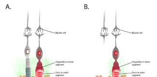 Figure showing progression of deterioration of rod and cone cells in retinitis pigmentosa.