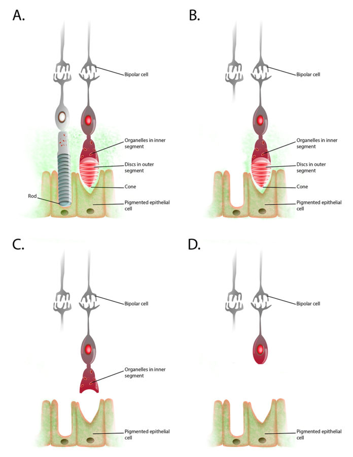 Figure showing progression of deterioration of rod and cone cells in retinitis pigmentosa.
