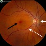 Photo showing normal eye with normal optic nerve (solid white), macula (black), and vessels (dash). Photo credit: Eyerounds.org. Image © and used with permission from The University of Iowa and EyeRounds.org.