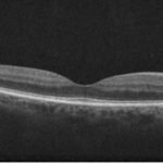 Ocular Coherence Tomography (OCT) scan of eye showing normal anatomy of the photoreceptor segments of retina. Image © E. Mitchel Opremcak, M.D., www.theretinagroup.com