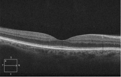 Photo showing solar photo-toxicity in the central retina, the yellow-white pigment irregularity in the center of the photo. Image © 2017 American Academy of Ophthalmology.