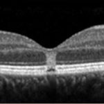 Ocular Coherence Tomography (OCT) scan showing focal disruption of the outer layers of the retina, seen as the rectangular area of atrophy in the center of the retina. Image © 2017 American Academy of Ophthalmology.