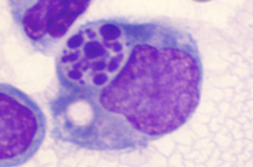 Image of macrophage digesting apoptotic, or dead cell