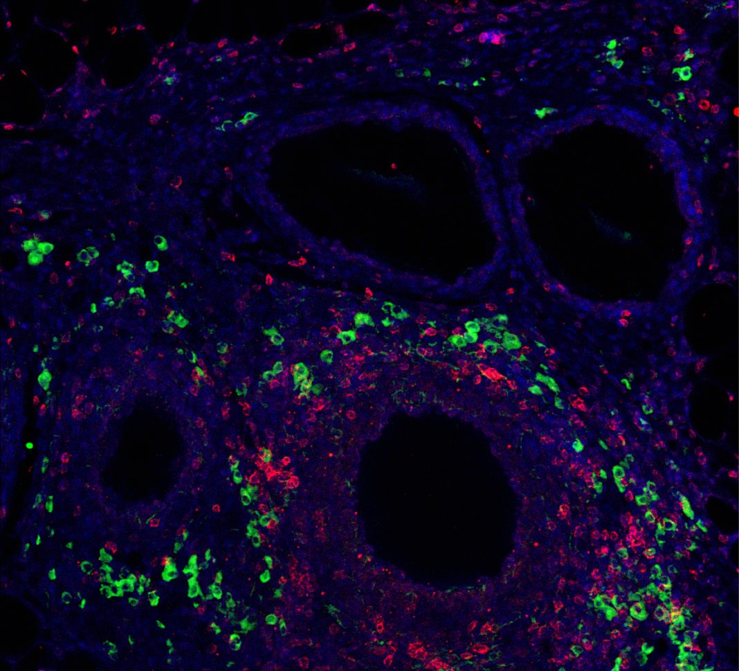 Immunomodulatory signal presentation via synthetic hydrogel material promotes generation of T regulatory cells (green) in the local graft microenvironment (CD3+ T cells in red, and nuclei staining in blue) after implantation into a clinically relevant transplant model for the treatment of type 1 diabetes. (Credit: Georgia Tech)