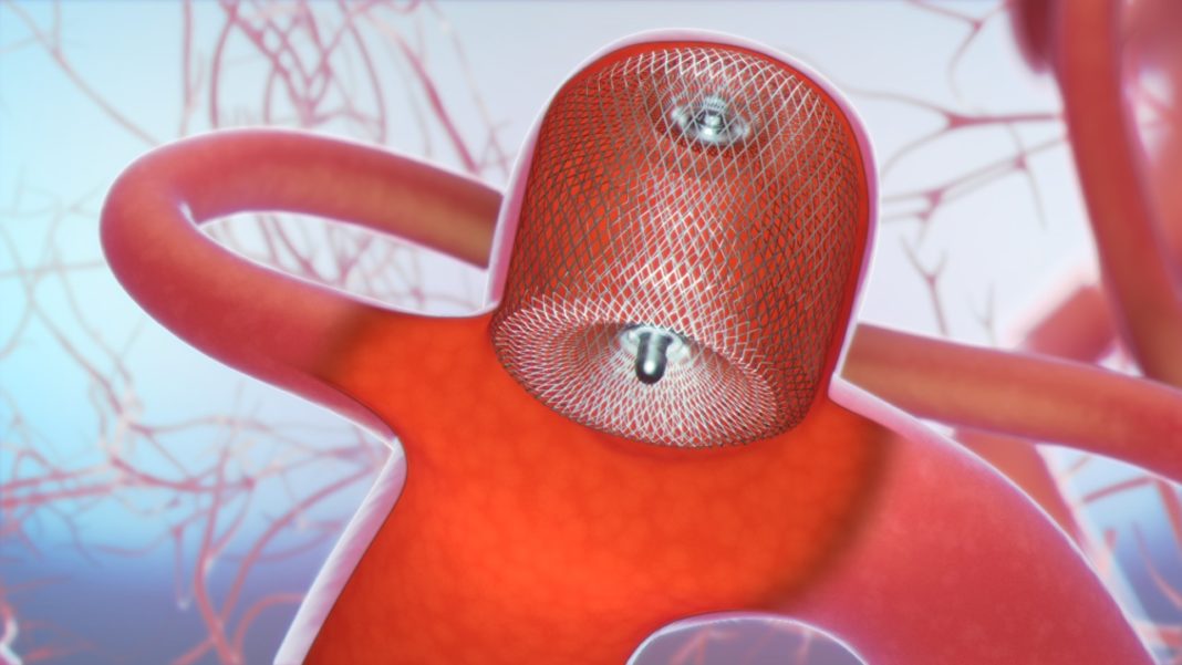 Illustration showing the WEB® Aneurysm Embolization System in place. MicroVention image.