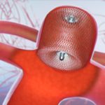 Illustration showing the WEB® Aneurysm Embolization System in place. MicroVention image.