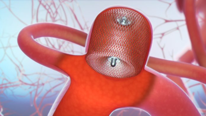 Illustration showing the WEB® Aneurysm Embolization System in place. MicroVention image.