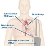 iVAS illustration courtesy NuPulseCV, Inc.