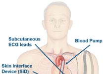 iVAS illustration courtesy NuPulseCV, Inc.