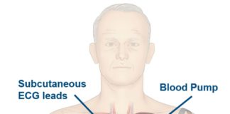 iVAS illustration courtesy NuPulseCV, Inc.