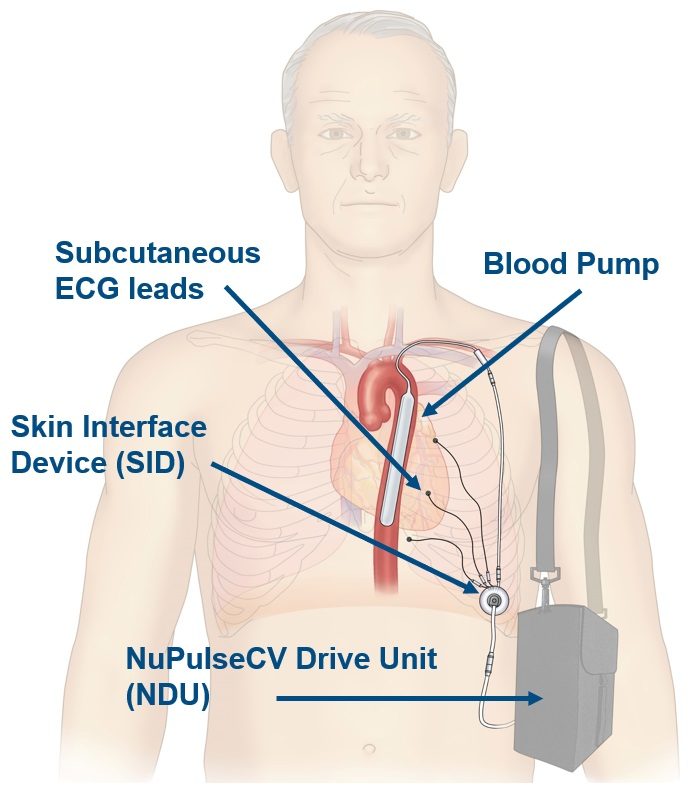 iVAS illustration courtesy NuPulseCV, Inc.