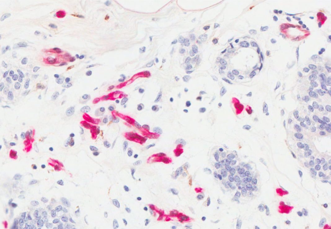 High expression of adipose fatty acid binding protein (FABP4) in mammary glands, shown in red, promotes obesity-associated breast cancer development.