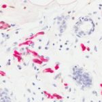 High expression of adipose fatty acid binding protein (FABP4) in mammary glands, shown in red, promotes obesity-associated breast cancer development.