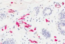 High expression of adipose fatty acid binding protein (FABP4) in mammary glands, shown in red, promotes obesity-associated breast cancer development.