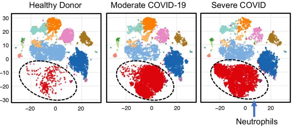 Uofl Immunologist Discovers Biomarker That Predicts A Crisis In Covid 19 Patients Uofl News