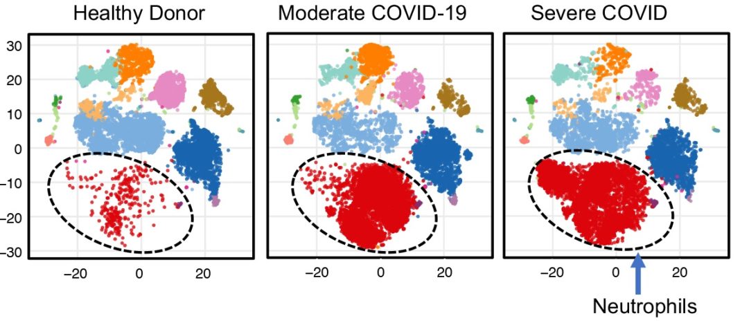 Diagram showing levels of neutrophil immune cells (red dots) in a healthy donor, a patient with moderate COVID-19 and a patient with severe COVID-19. Data analysis by Corey T. Watson, Ph.D., David Tieri, Ph.D., and M.D./Ph.D. student Anne Geller.