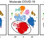 Diagram showing levels of neutrophil immune cells (red dots) in a healthy donor, a patient with moderate COVID-19 and a patient with severe COVID-19. Data analysis by Corey T. Watson, Ph.D., David Tieri, Ph.D., and M.D./Ph.D. student Anne Geller.