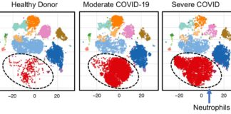 Diagram showing levels of neutrophil immune cells (red dots) in a healthy donor, a patient with moderate COVID-19 and a patient with severe COVID-19. Data analysis by Corey T. Watson, Ph.D., David Tieri, Ph.D., and M.D./Ph.D. student Anne Geller.