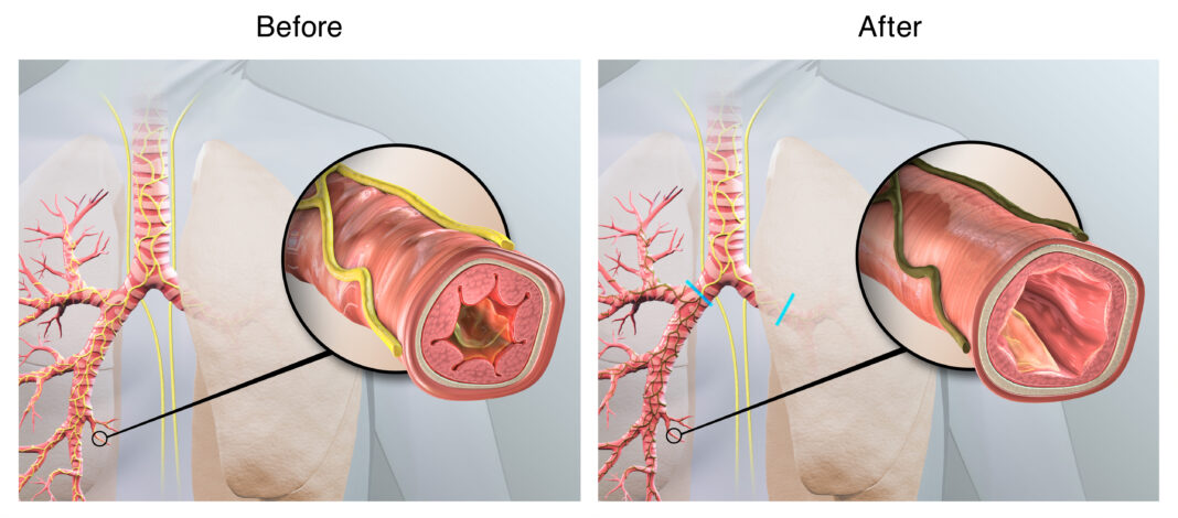 Targeted lung denervation (TLD) is designed to disrupt pulmonary nerve reflexes, which may have the potential to reduce COPD exacerbations. Illustration courtesy Nuvaira Inc.