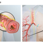 Targeted lung denervation (TLD) is designed to disrupt pulmonary nerve reflexes, which may have the potential to reduce COPD exacerbations. Illustration courtesy Nuvaira Inc.