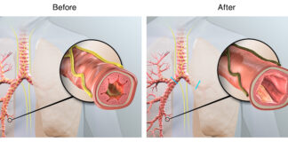 Targeted lung denervation (TLD) is designed to disrupt pulmonary nerve reflexes, which may have the potential to reduce COPD exacerbations. Illustration courtesy Nuvaira Inc.