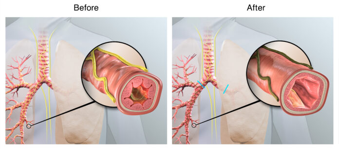 Targeted lung denervation (TLD) is designed to disrupt pulmonary nerve reflexes, which may have the potential to reduce COPD exacerbations. Illustration courtesy Nuvaira Inc.