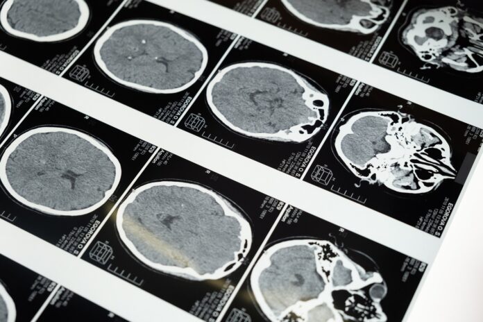 Image of brain MRI scans by Cottonbro via Pexels
