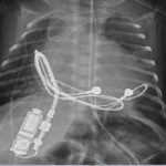 tiny pacemaker implant