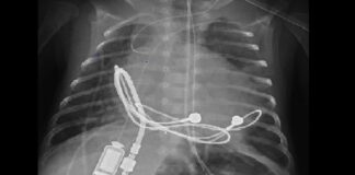 tiny pacemaker implant