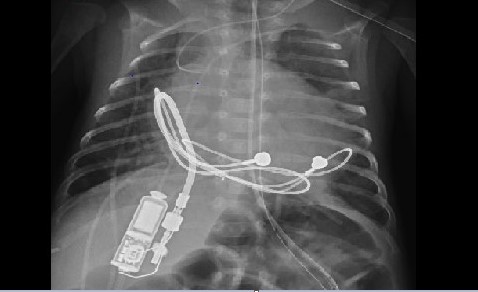 tiny pacemaker implant